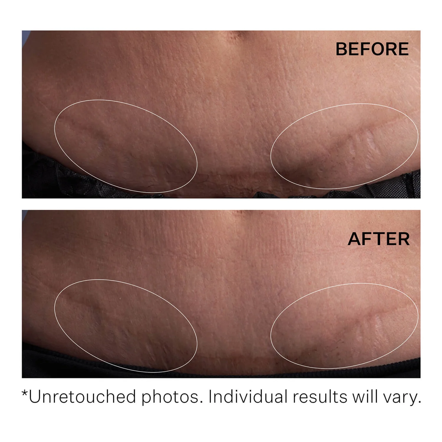 StriVectin SD Advanced PLUS Intensive Moisturising Concentrate 118ml 6 StriVectin SD Advanced PLUS Intensive Moisturising Concentrate 118ml - Image 6